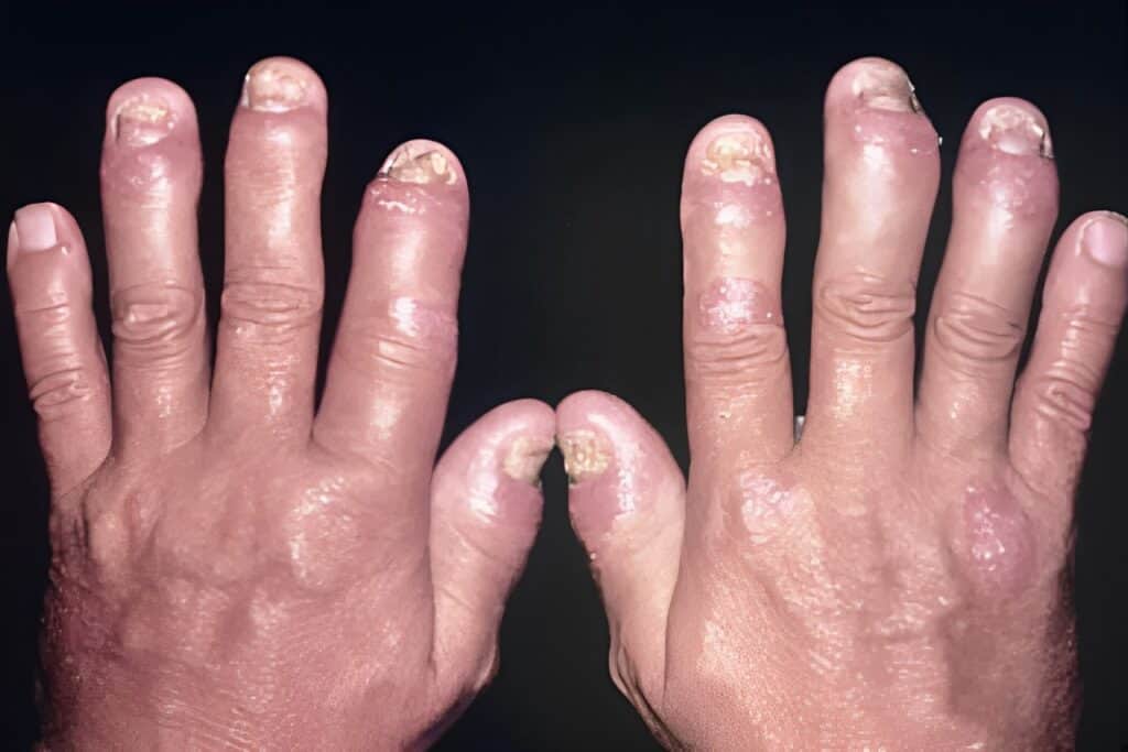 Exploring Systemic Autoimmune Diseases 3 Hands with swollen, inflamed fingers and damaged nails.