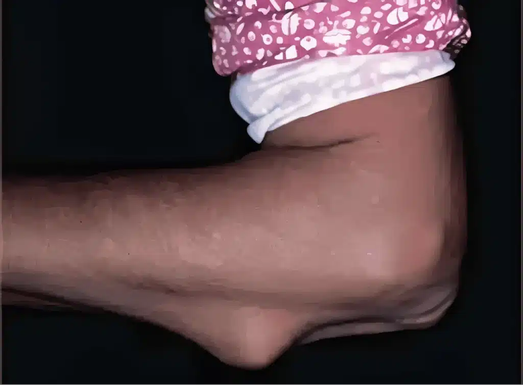 Exploring Systemic Autoimmune Diseases 6 Arm with swollen elbow and rash.