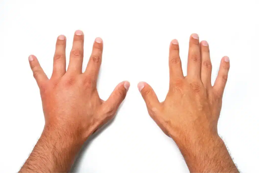 Recognizing the Common Symptoms of Arthritis 4 unnamed 5 8