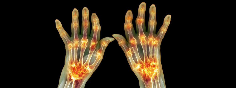 Autoimmune Arthritis
