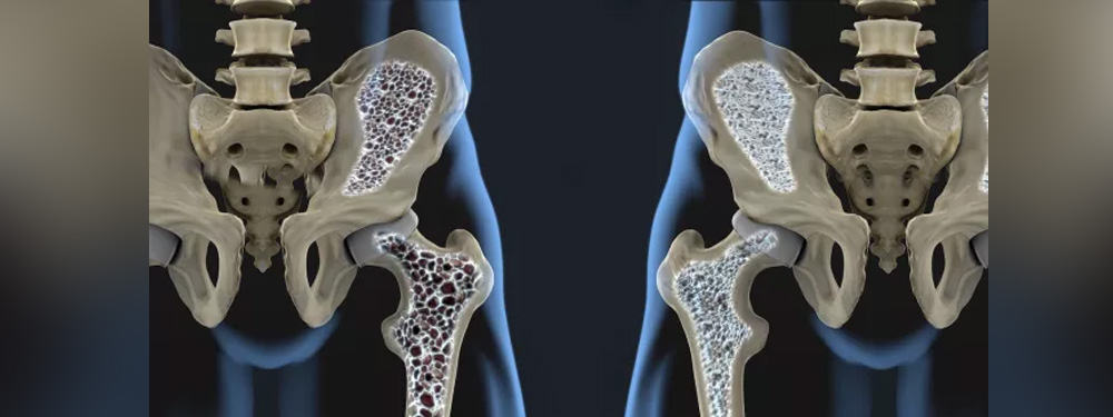 Bone Density Disorders